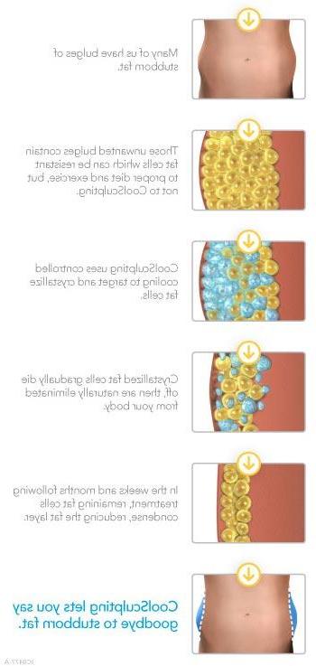 How CoolSculpting works